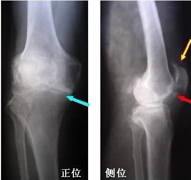 骨质增生典型案例