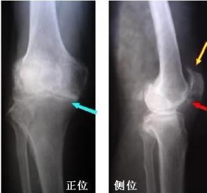 骨质增生典型案例